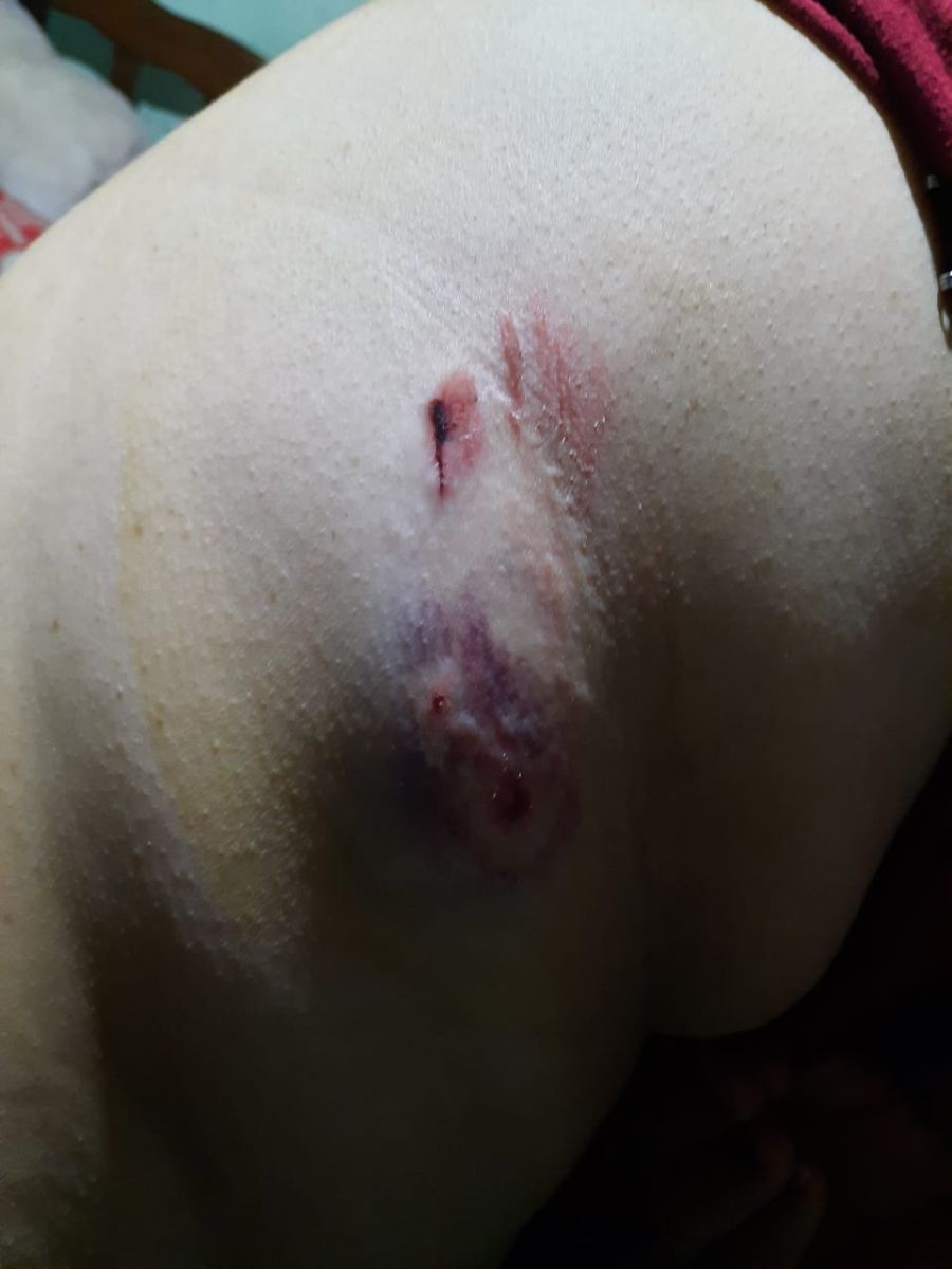 El testimonio de una vecina que fue brutalmente mordida por dos perros 