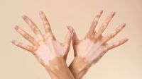 Día Mundial del Vitiligo: concientización, impacto emocional y los prometedores avances médicos hacia el futuro